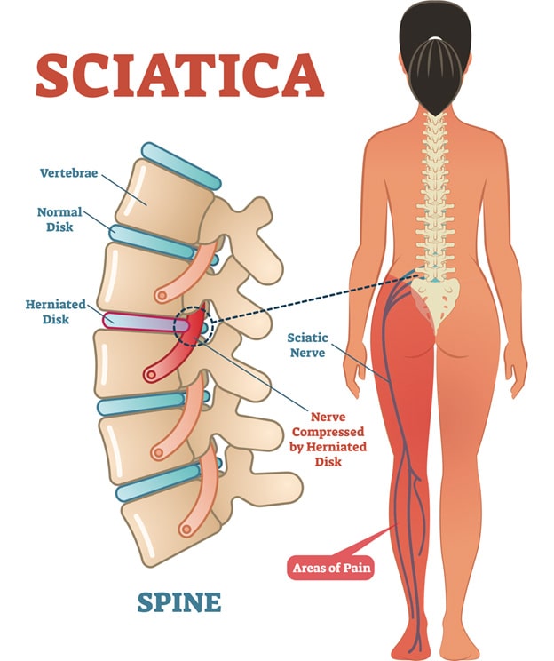 Can Prolonged Sitting Cause Sciatica?